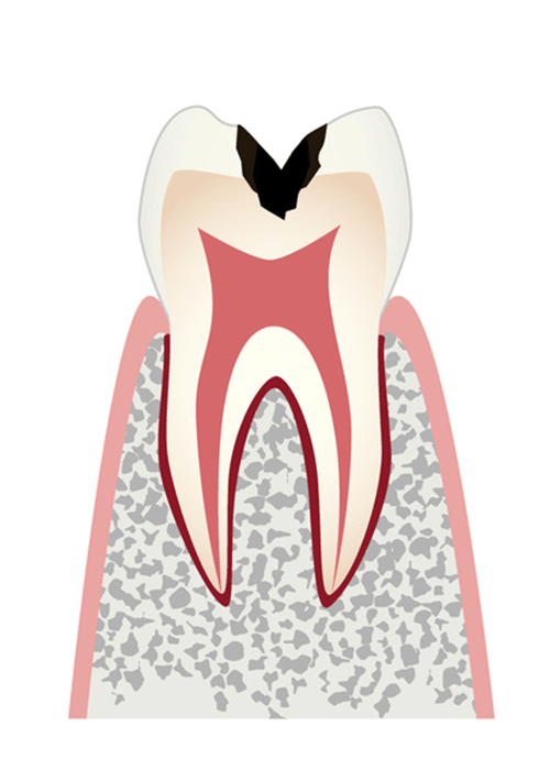 象牙質＝エナメル質のすぐ下にあり神経を守っている組織のむし歯